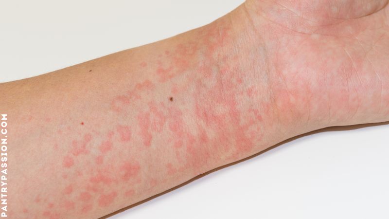 skin rash on arm - do larder beetles bite humans?